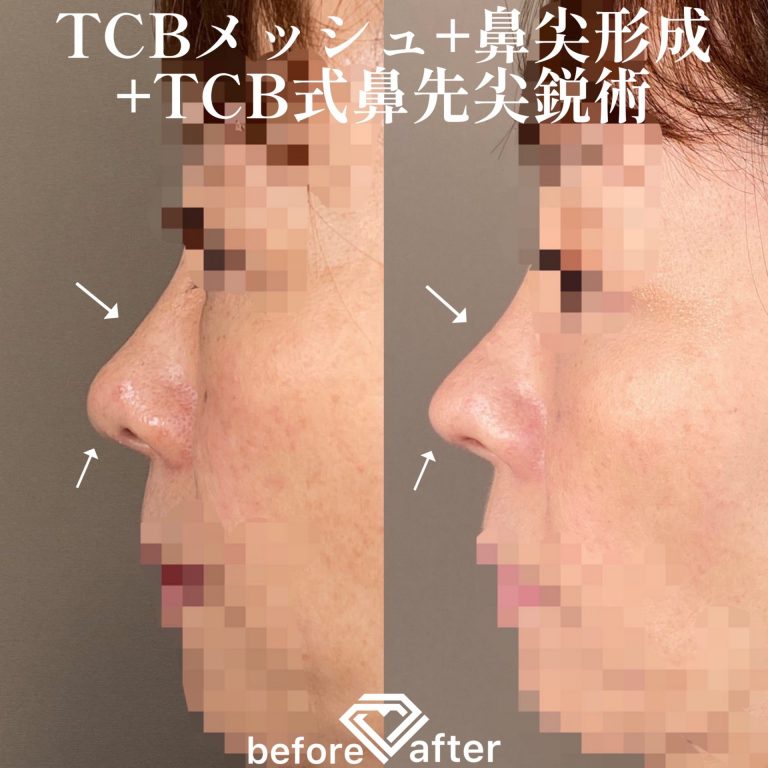 鼻尖形成(担当医:TCB 医師)の症例写真3