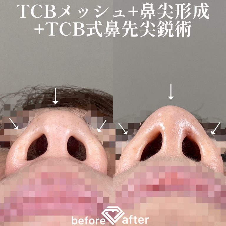 鼻尖形成(担当医:TCB 医師)の症例写真4