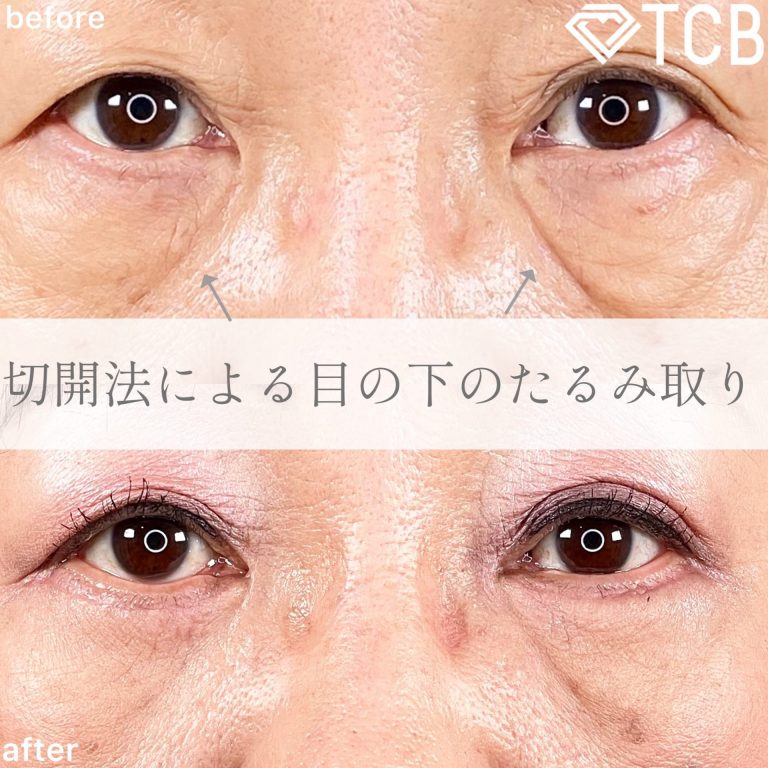 切開法による目の下のたるみ取り（下眼瞼除皺術）(担当医:森本 理一郎 医師)の症例写真1