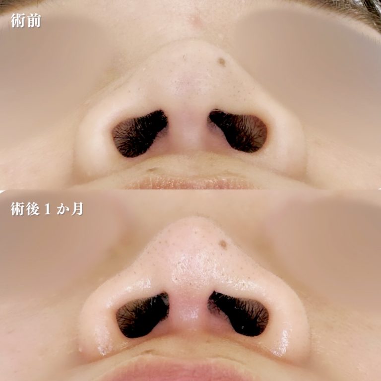 TCB式鼻先尖鋭術（だんご鼻解消）(担当医:林 一樹 医師)の症例写真1