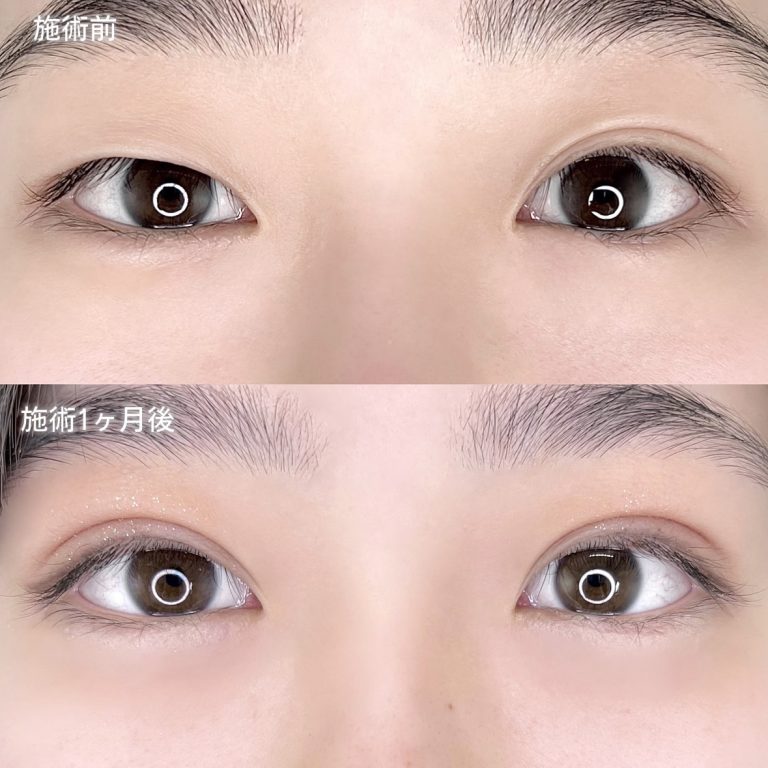 二重埋没法(担当医:TCB 医師)の症例写真1