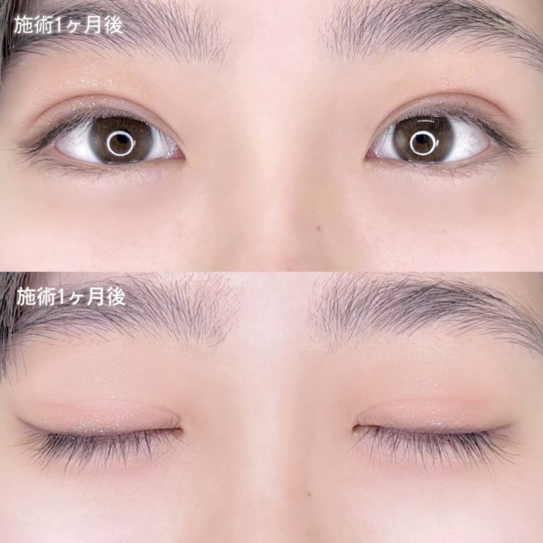 二重埋没法(担当医:TCB 医師)の症例写真2