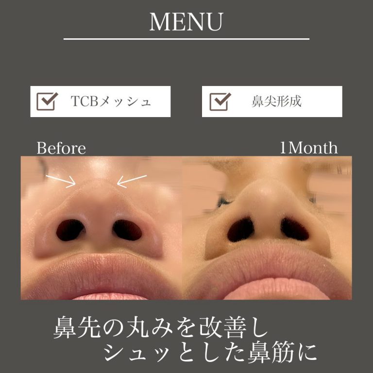 鼻尖形成(担当医:鎌田 紀美子 医師)の症例写真2