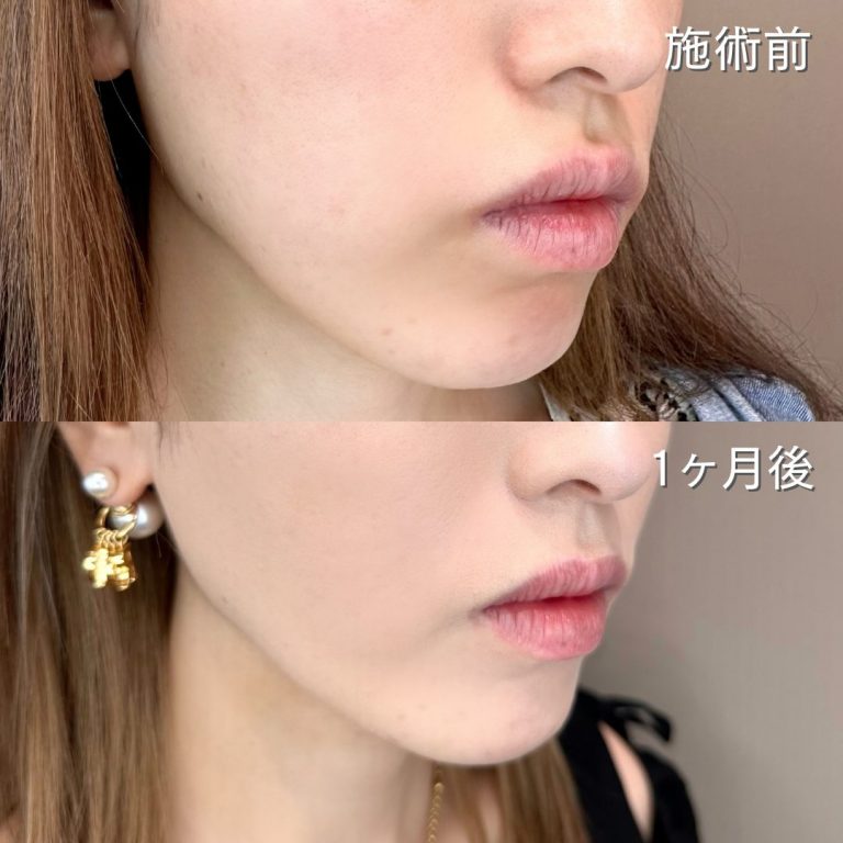小顔美肌再生（リフトアップ）(担当医:TCB 医師)の症例写真2