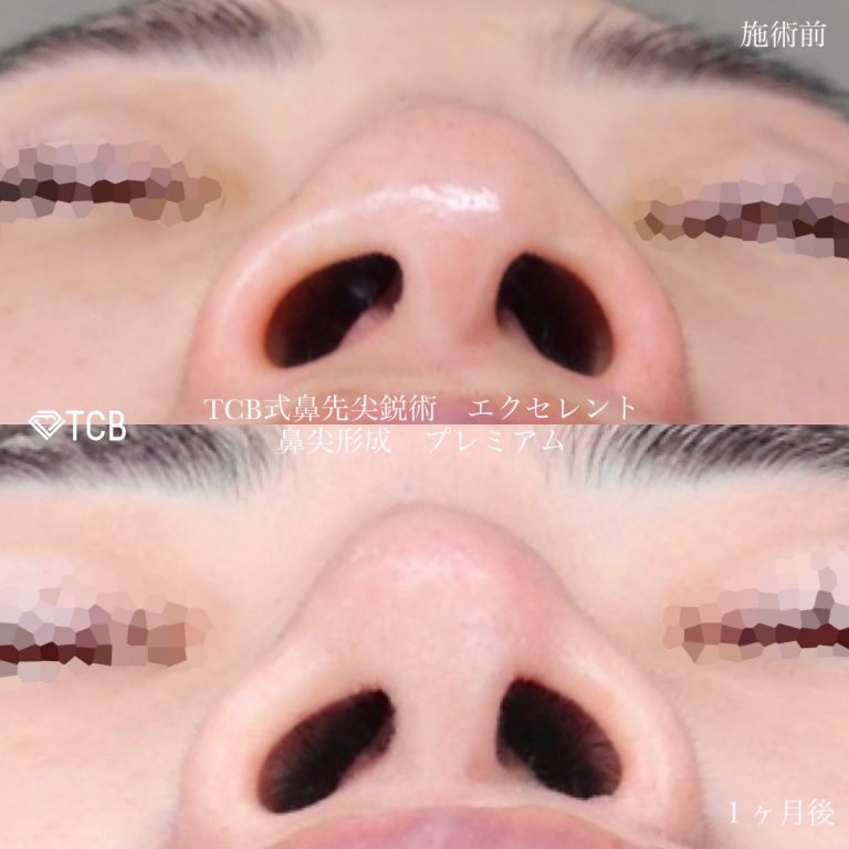 鼻尖形成(担当医:寺西 宏王 医師)の症例写真1