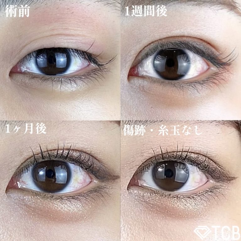 二重埋没法(担当医:TCB 医師)の症例写真1