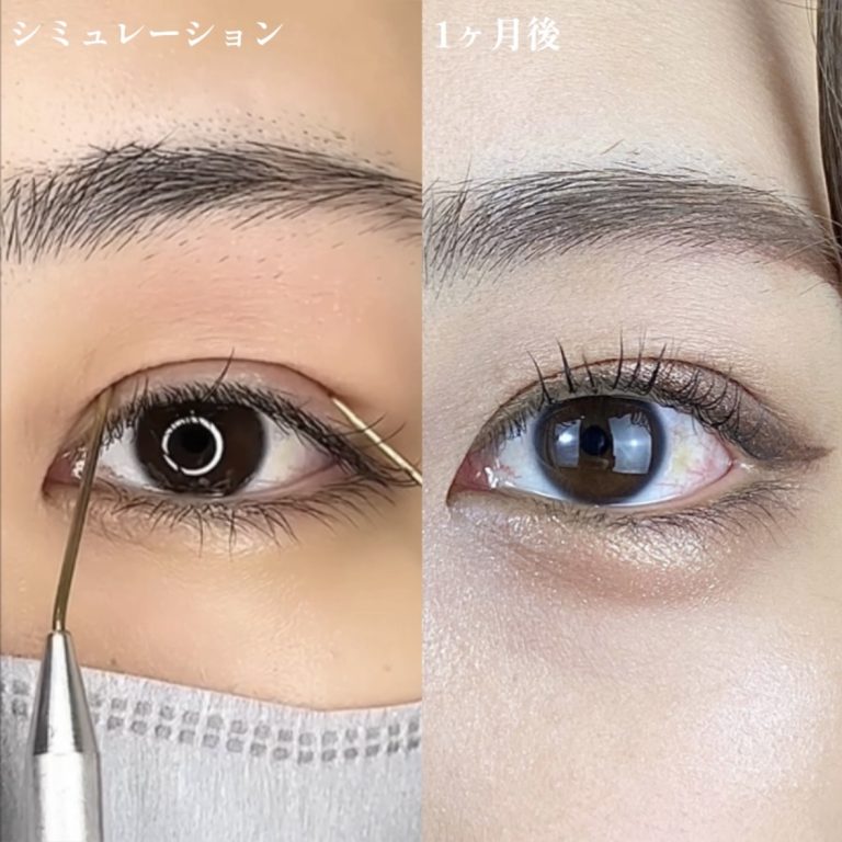 二重埋没法(担当医:TCB 医師)の症例写真2