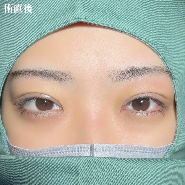 二重埋没法(担当医:TCB 医師)の症例写真3