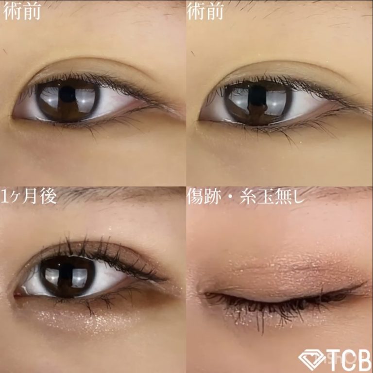 二重埋没法(担当医:TCB 医師)の症例写真1