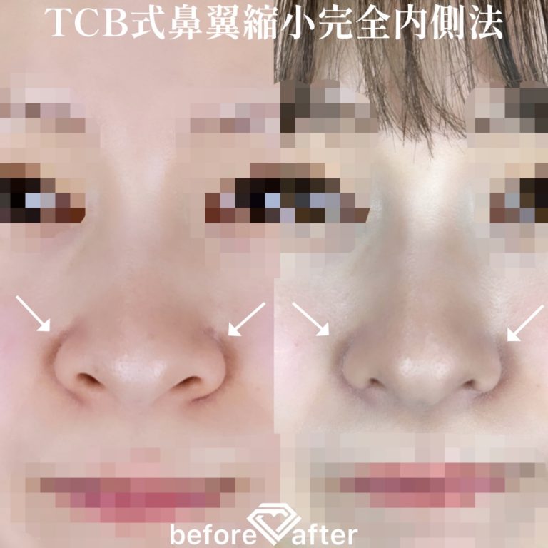 TCB式鼻翼縮小完全内側法・外側法(担当医:TCB 医師)の症例写真1