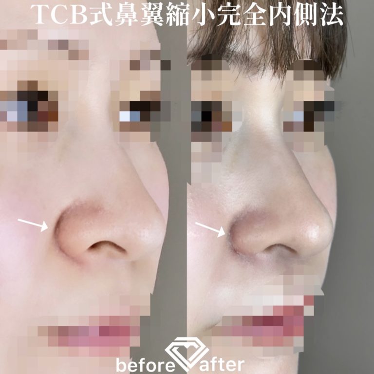 TCB式鼻翼縮小完全内側法・外側法(担当医:TCB 医師)の症例写真2