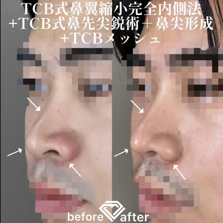 鼻尖形成(担当医:TCB 医師)の症例写真2