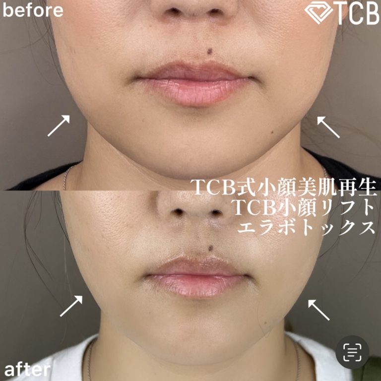 小顔美肌再生（リフトアップ）(担当医:TCB 医師)の症例写真1