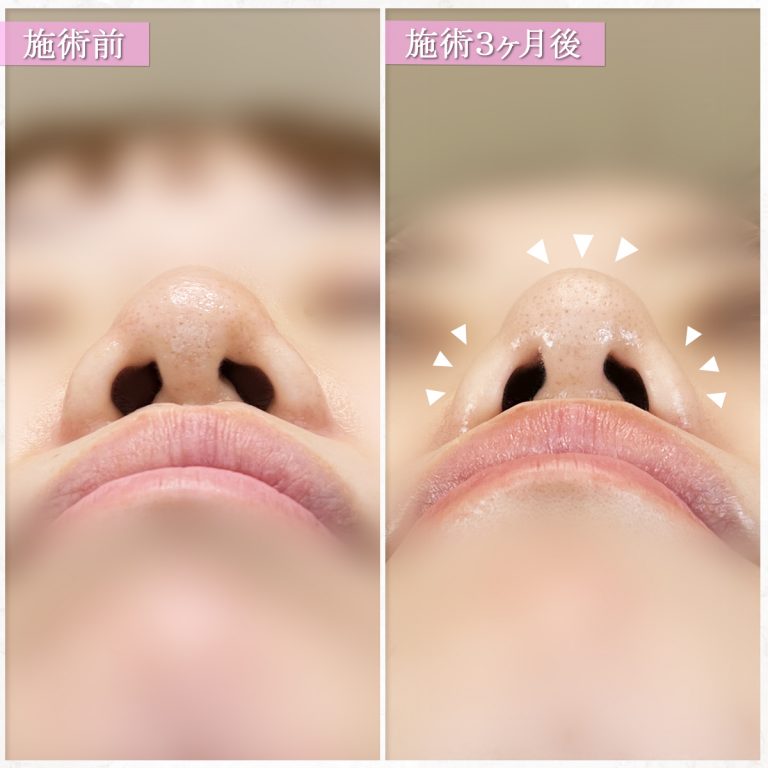 TCB式鼻翼縮小完全内側法(担当医:篠永 宏行 医師)の症例写真2