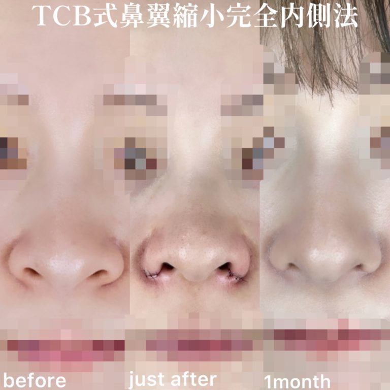 TCB式鼻翼縮小完全内側法・外側法(担当医:TCB 医師)の症例写真3