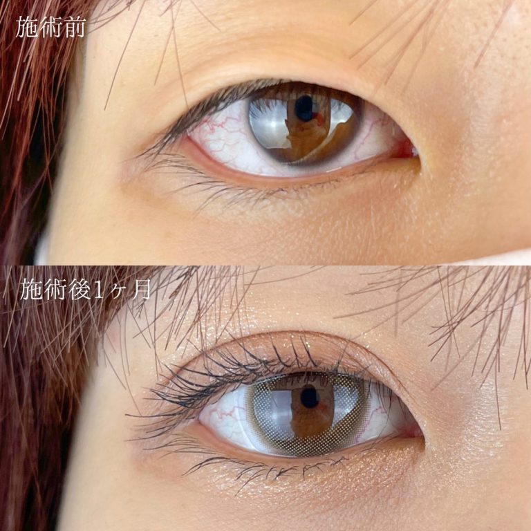 二重埋没法(担当医:TCB 医師)の症例写真2