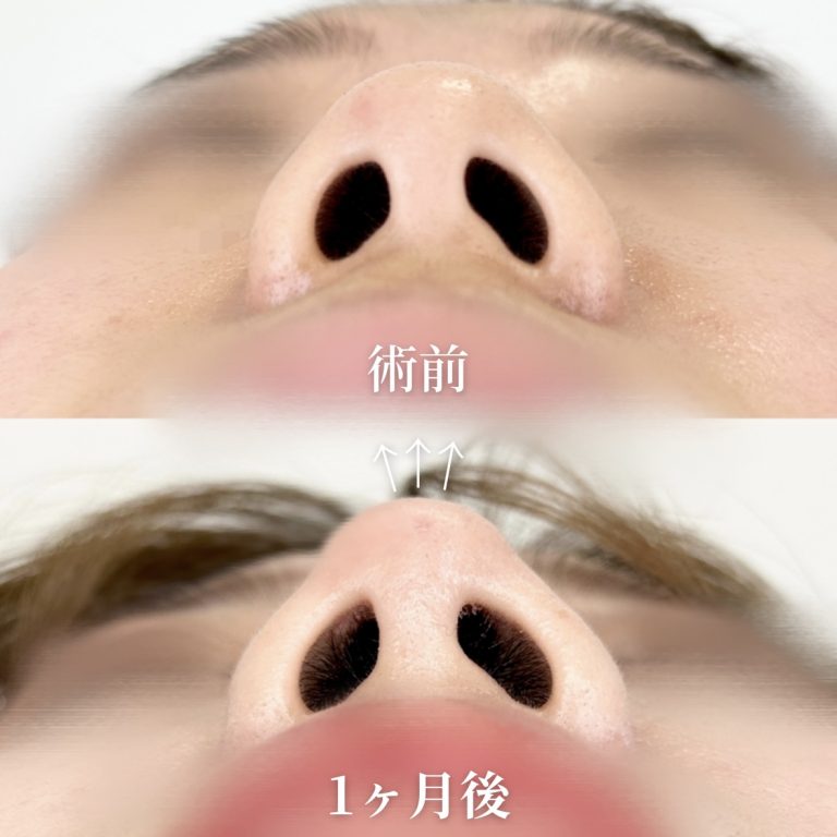 鼻尖形成(担当医:垣花 瑠美子 医師)の症例写真1
