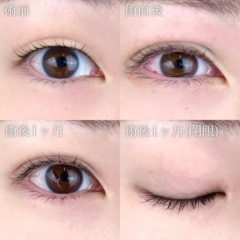 二重埋没法(担当医:TCB 医師)の症例写真1