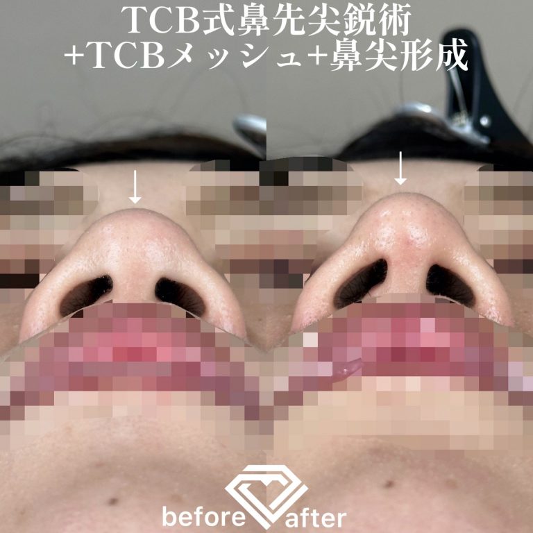 鼻尖形成(担当医:森本 理一郎 医師)の症例写真4