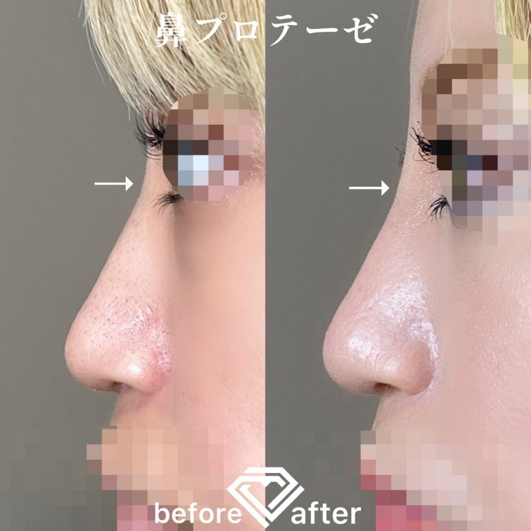 鼻プロテーゼ（隆鼻術）(担当医:森本 理一郎 医師)の症例写真3