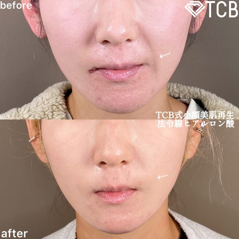 小顔美肌再生（リフトアップ）(担当医:TCB 医師)の症例写真1