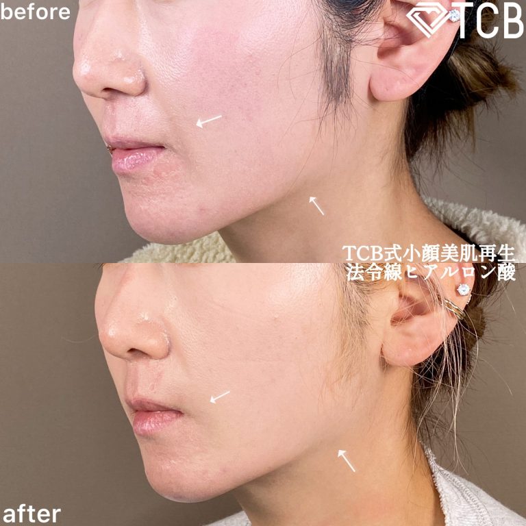 小顔美肌再生（リフトアップ）(担当医:TCB 医師)の症例写真2