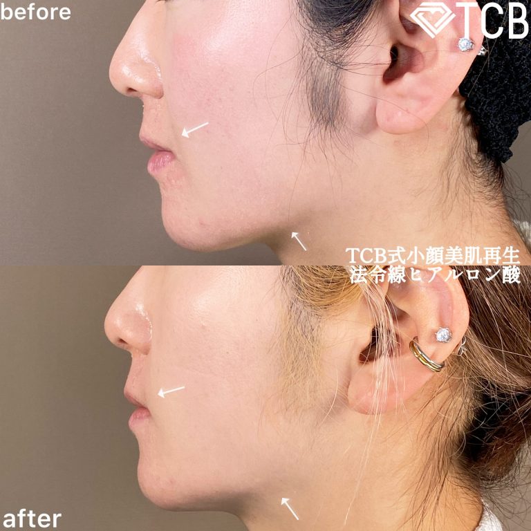 小顔美肌再生（リフトアップ）(担当医:TCB 医師)の症例写真3