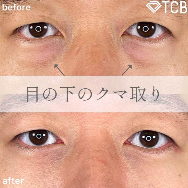 切らない目の下のクマ取り・目の下のたるみ（ふくらみ）取り(担当医:森本 理一郎 医師)の症例写真1