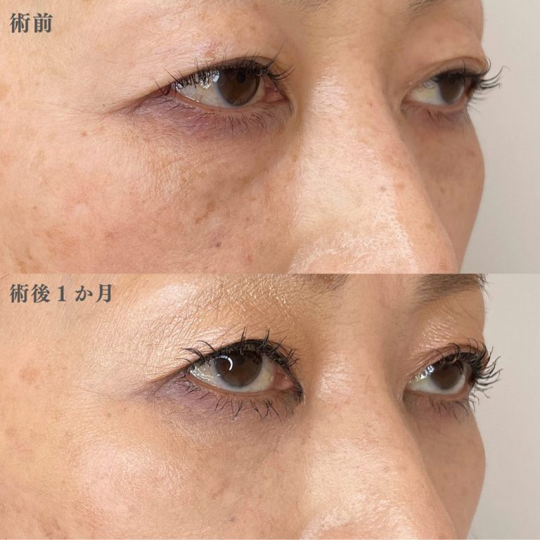 切らない目の下のクマ取り・目の下のたるみ（ふくらみ）取り(担当医:林 一樹 医師)の症例写真2