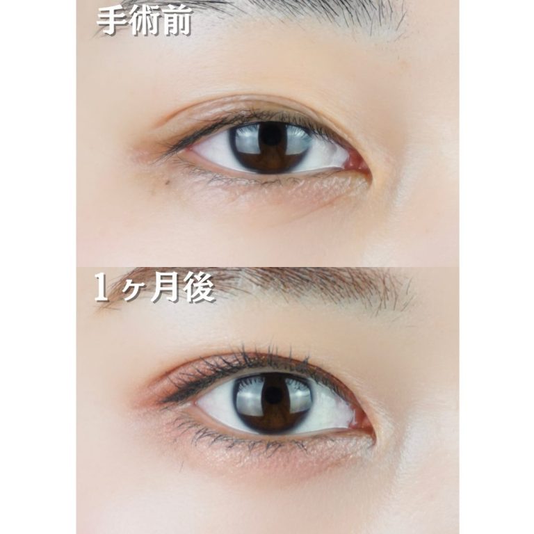 二重埋没法(担当医:TCB 医師)の症例写真1