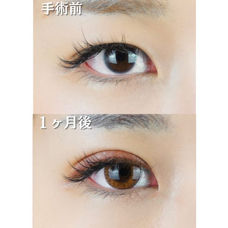 二重埋没法(担当医:TCB 医師)の症例写真1
