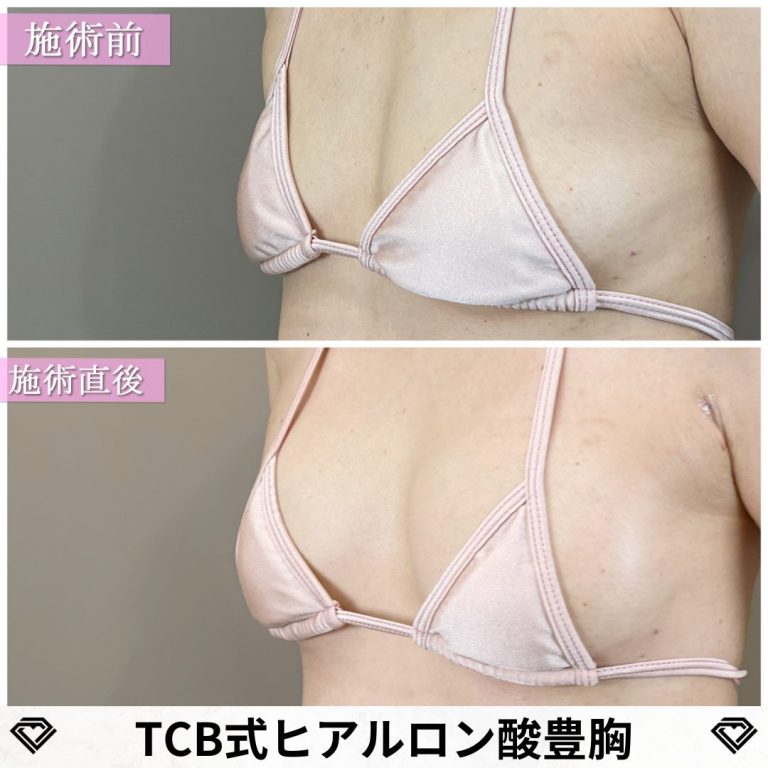 TCB式ヒアルロン酸豊胸(担当医:篠永 宏行 医師)の症例写真1