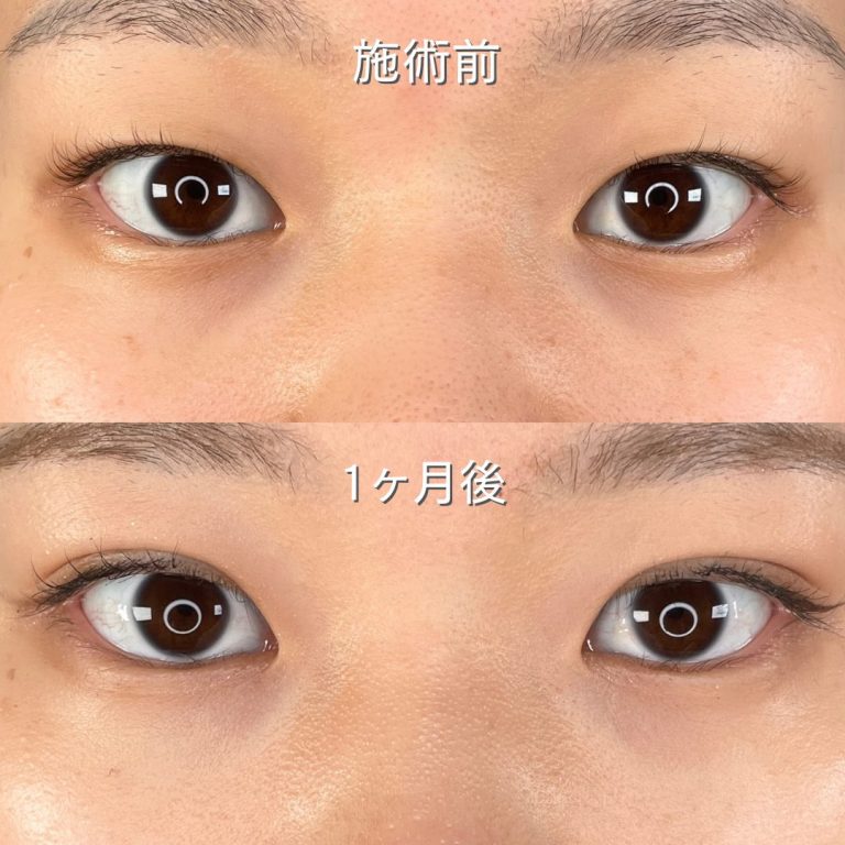 二重埋没法(担当医:TCB 医師)の症例写真1