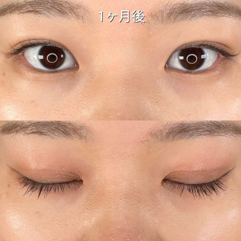 二重埋没法(担当医:TCB 医師)の症例写真2