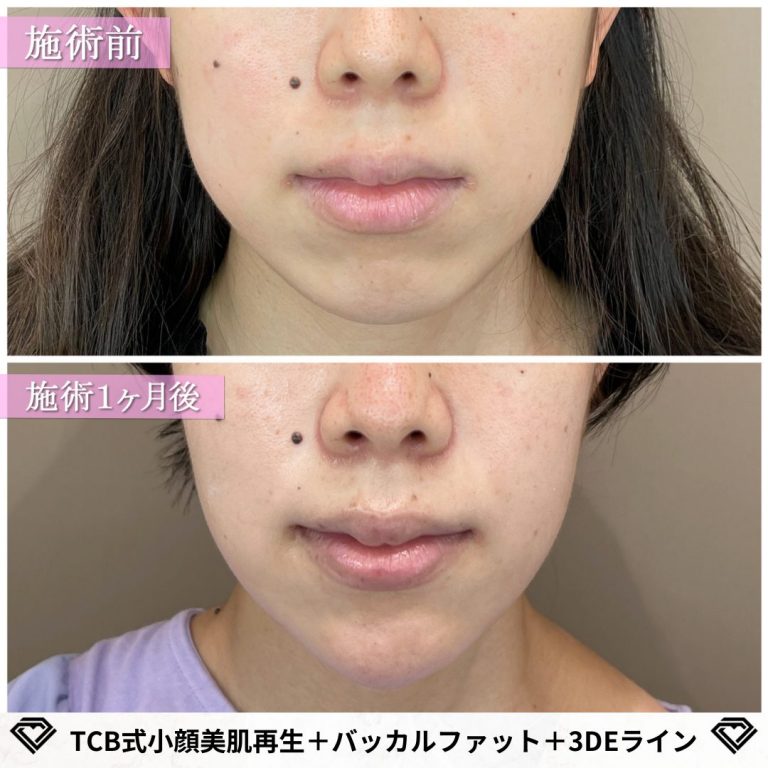 小顔美肌再生（リフトアップ）(担当医:TCB 医師)の症例写真1
