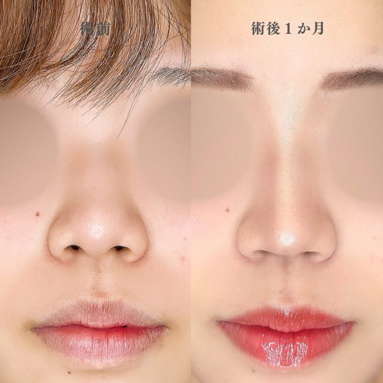 鼻尖形成(担当医:林 一樹 医師)の症例写真2