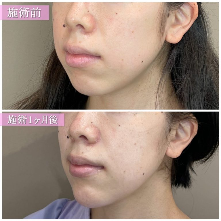 小顔美肌再生（リフトアップ）(担当医:TCB 医師)の症例写真2