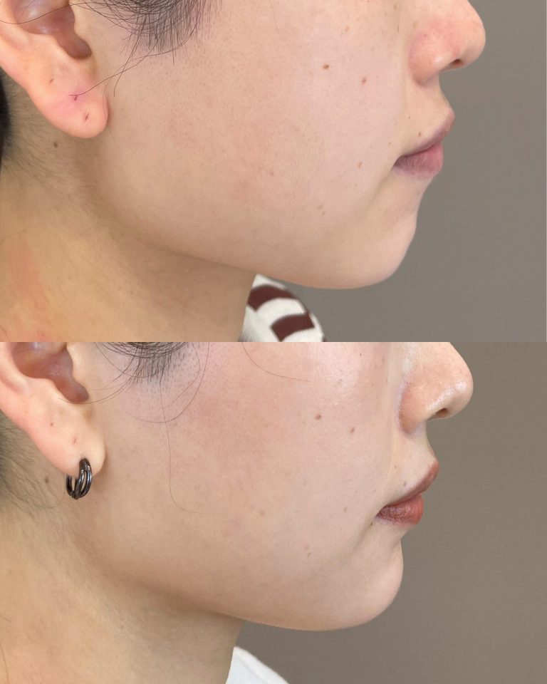 顎（あご）のヒアルロン酸注射(担当医:佐藤 麻未 医師)の症例写真1