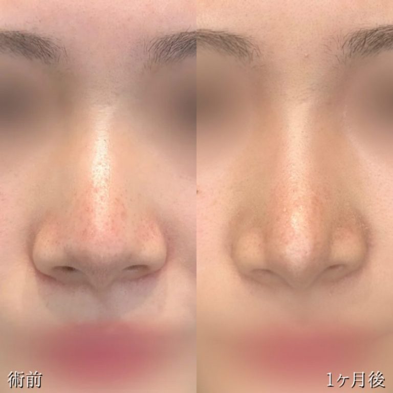 鼻尖形成(担当医:伊藤 富良野 医師)の症例写真1