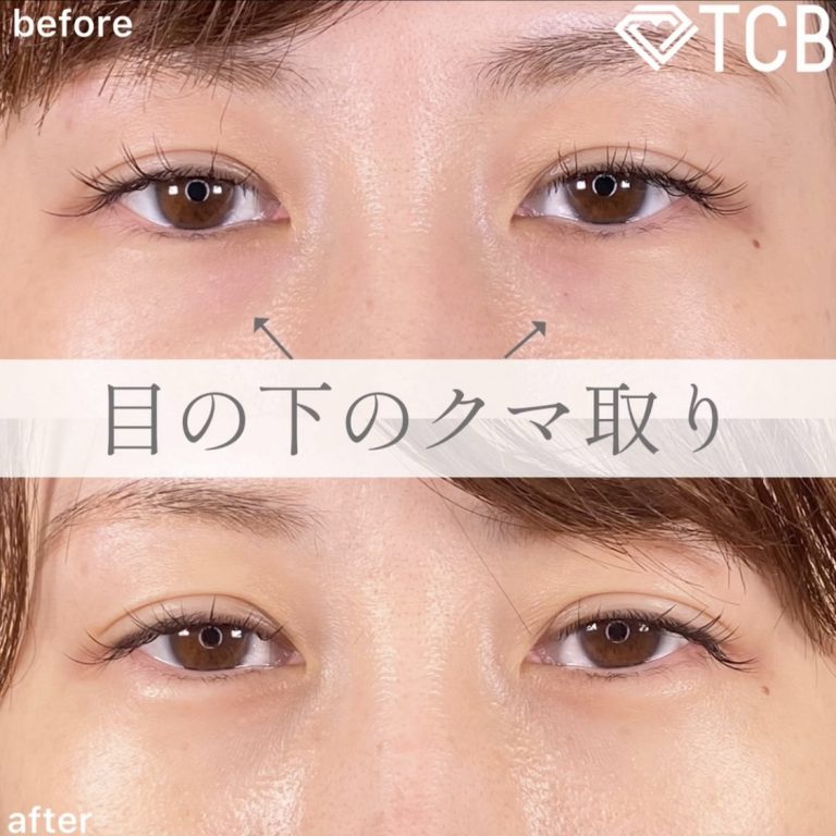 切らない目の下のクマ取り・目の下のたるみ（ふくらみ）取り(担当医:TCB 医師)の症例写真1