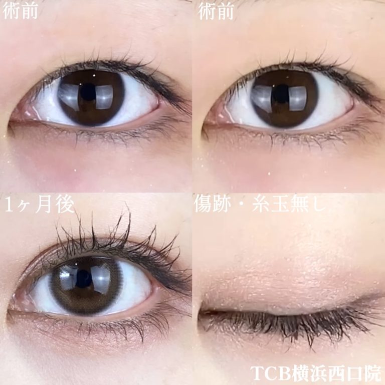 二重埋没法(担当医:TCB 医師)の症例写真1