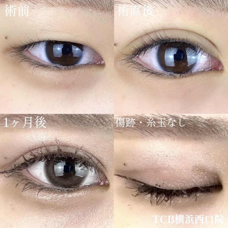 二重埋没法(担当医:TCB 医師)の症例写真1
