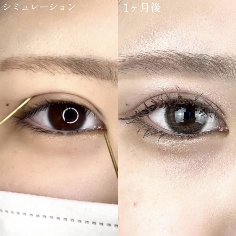 二重埋没法(担当医:TCB 医師)の症例写真3