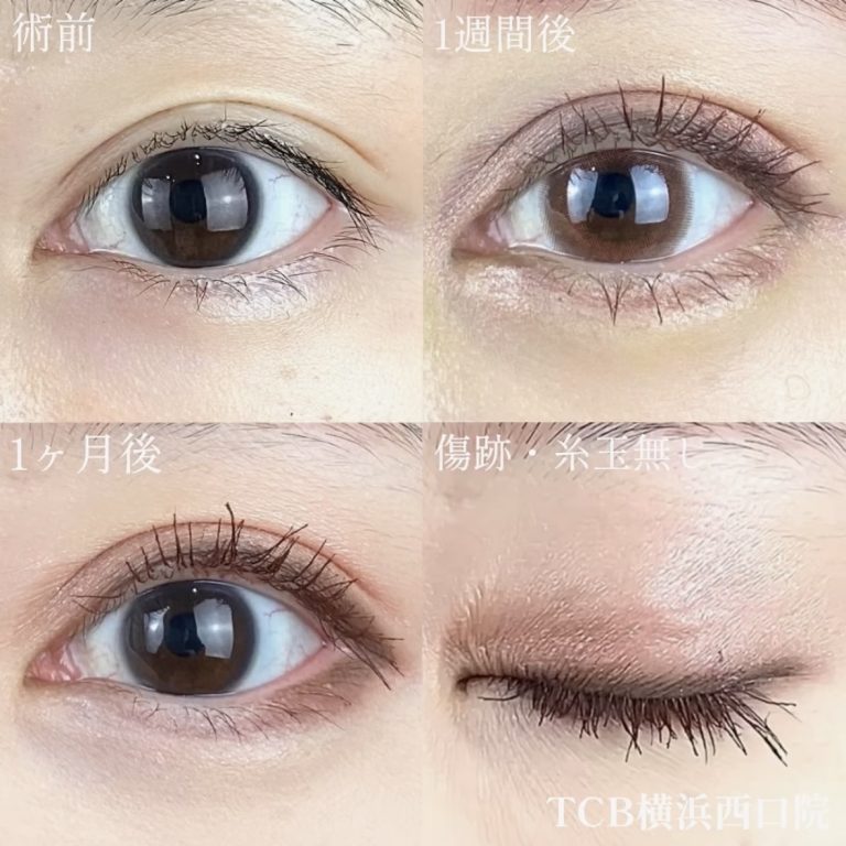 二重埋没法(担当医:TCB 医師)の症例写真1
