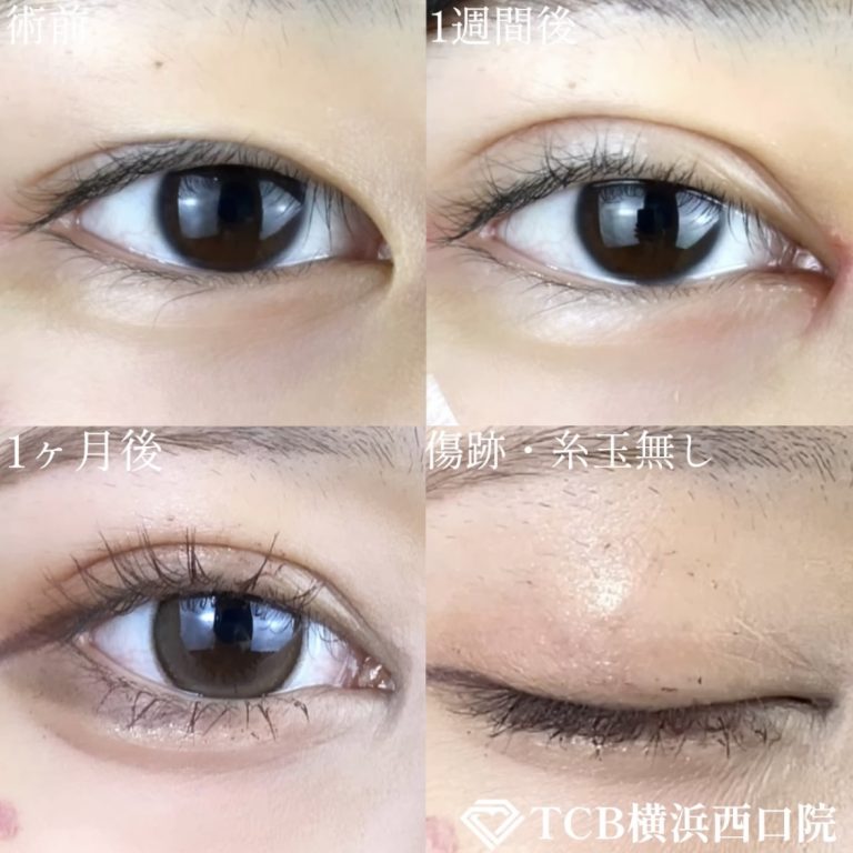 二重埋没法(担当医:TCB 医師)の症例写真1