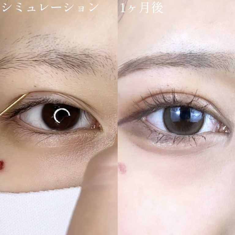 二重埋没法(担当医:TCB 医師)の症例写真3