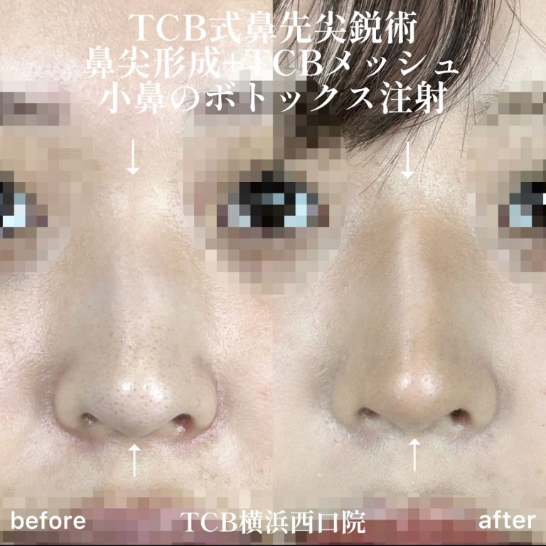 TCB式鼻先尖鋭術（だんご鼻解消）(担当医:森本 理一郎 医師)の症例写真1