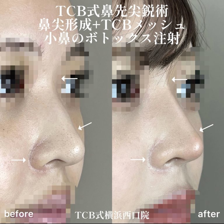 TCB式鼻先尖鋭術（だんご鼻解消）(担当医:TCB 医師)の症例写真2