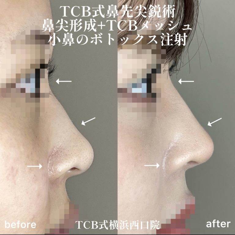 TCB式鼻先尖鋭術（だんご鼻解消）(担当医:TCB 医師)の症例写真3