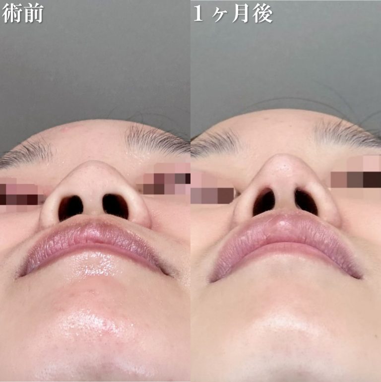 鼻尖形成(担当医:渡邉 正士 医師)の症例写真3